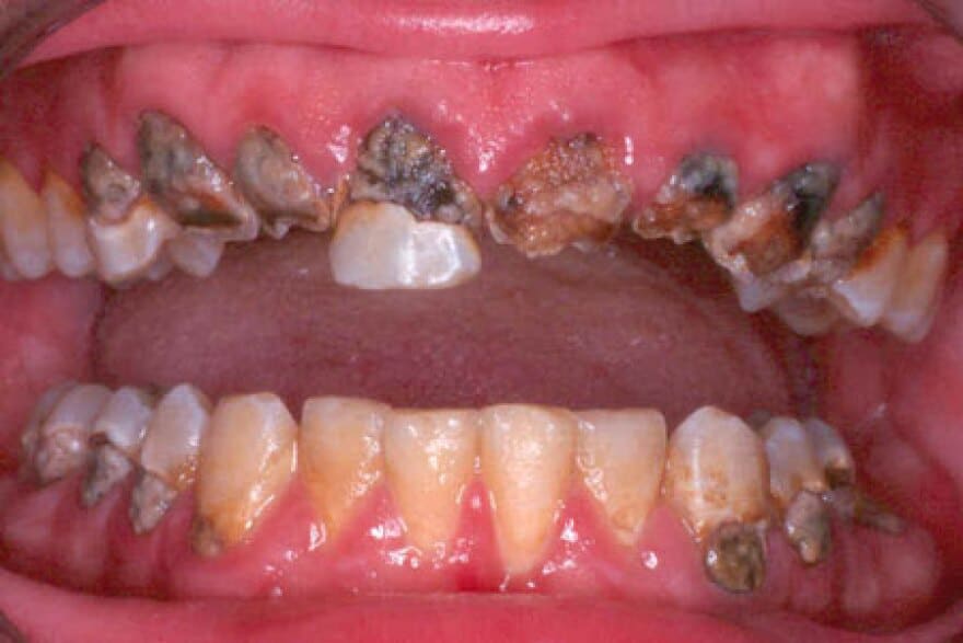 Major damage to this patient's teeth and gums.