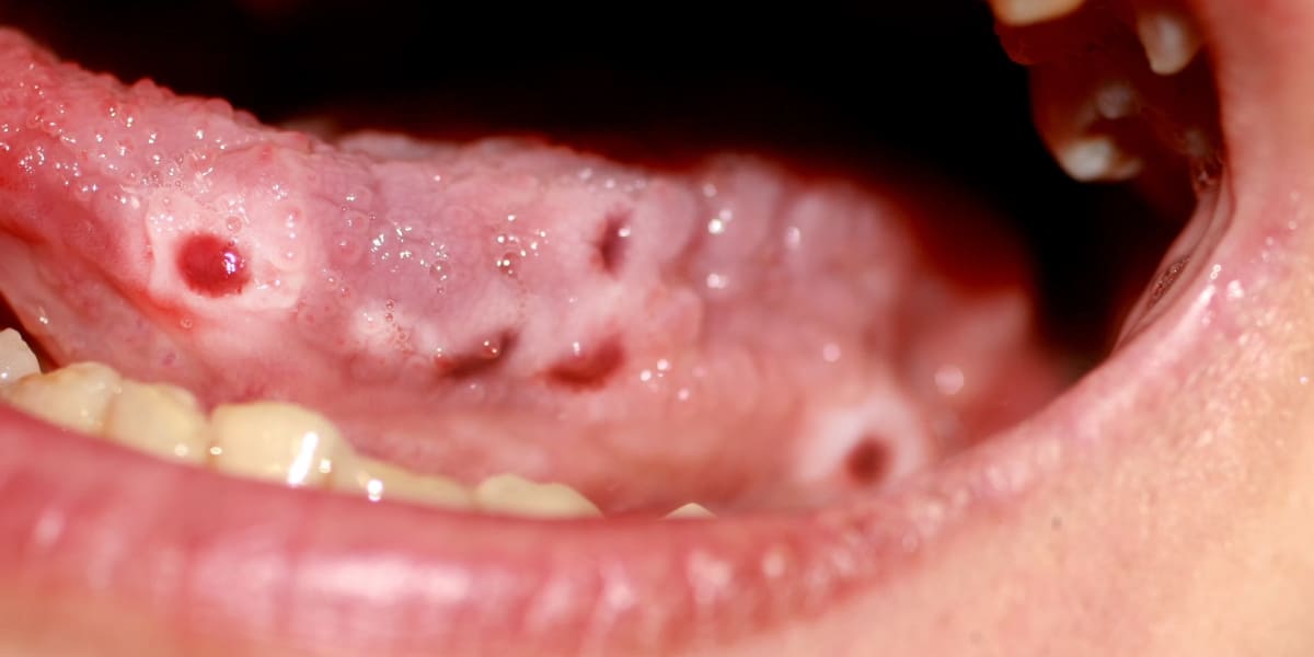A patient experiencing blisters on the tongue; due to over usage of meth.