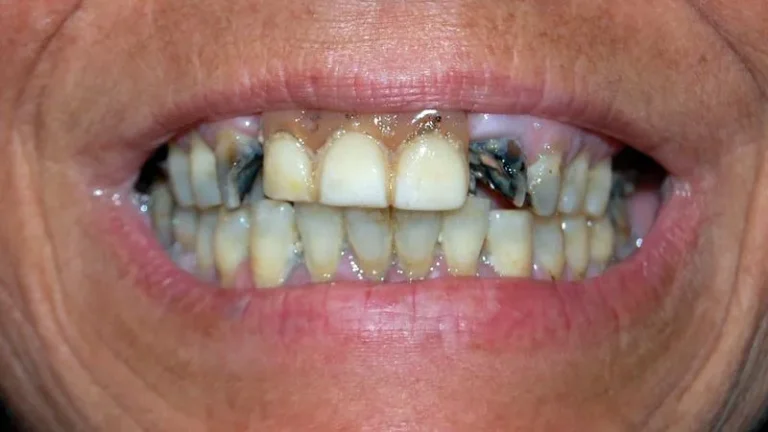 A patient experiencing meth mouth on both top and bottom teeth.