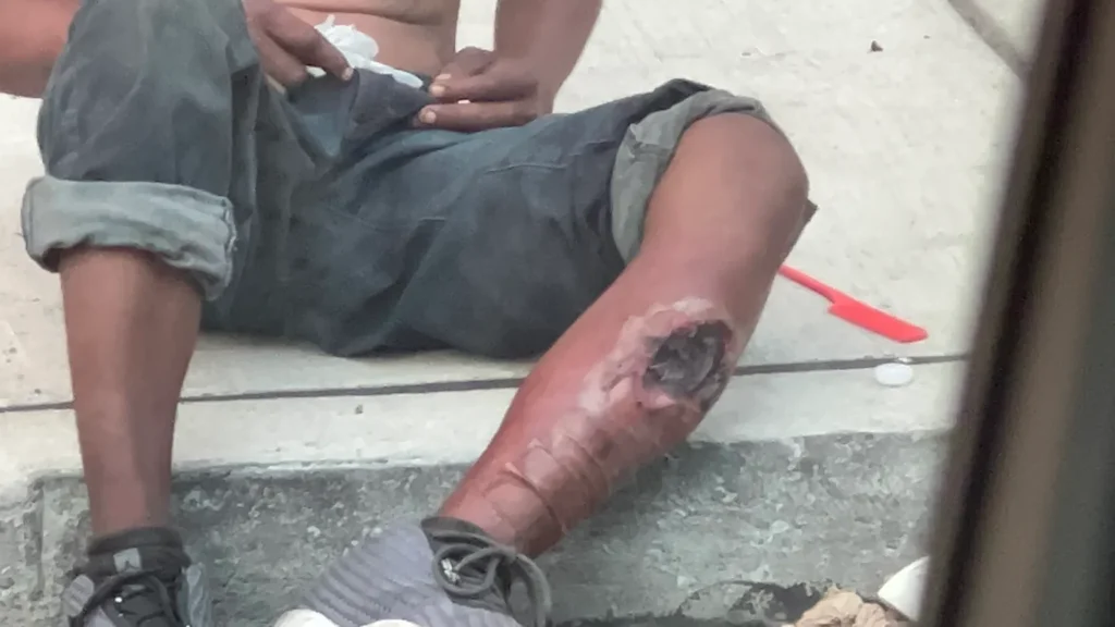 A man suffering from xylazine leg; requires amputation.