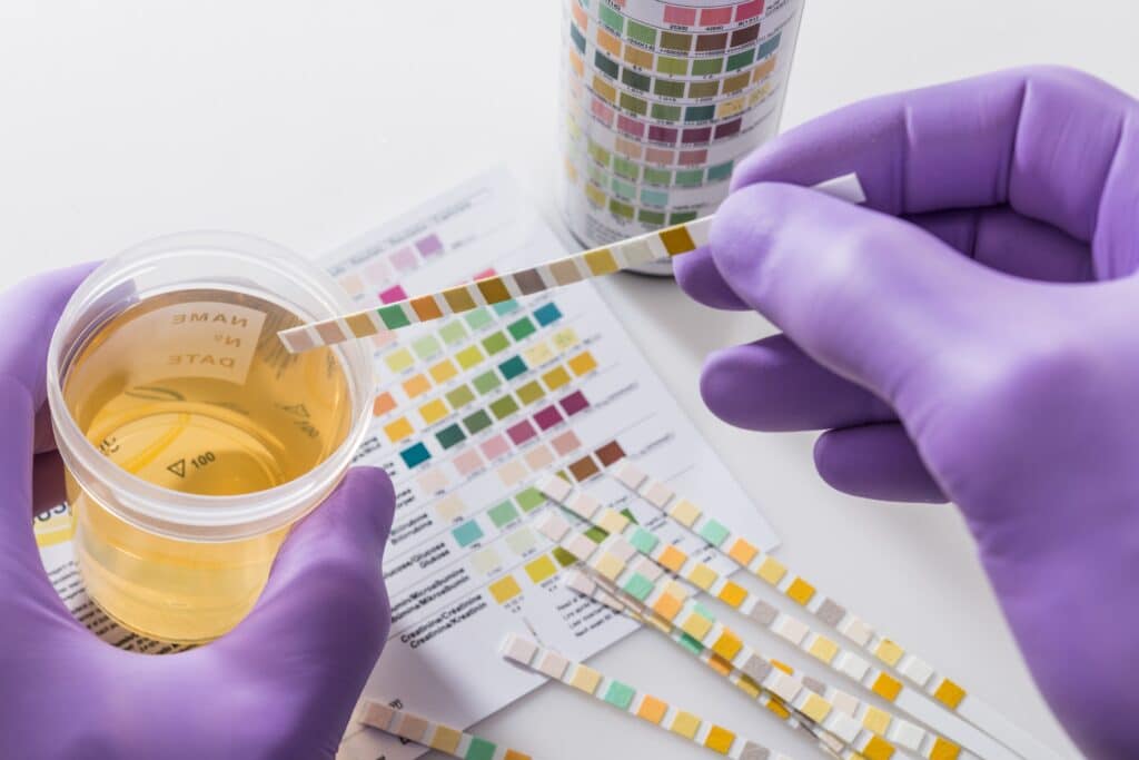 Lab personal testing a urine sample with strips.