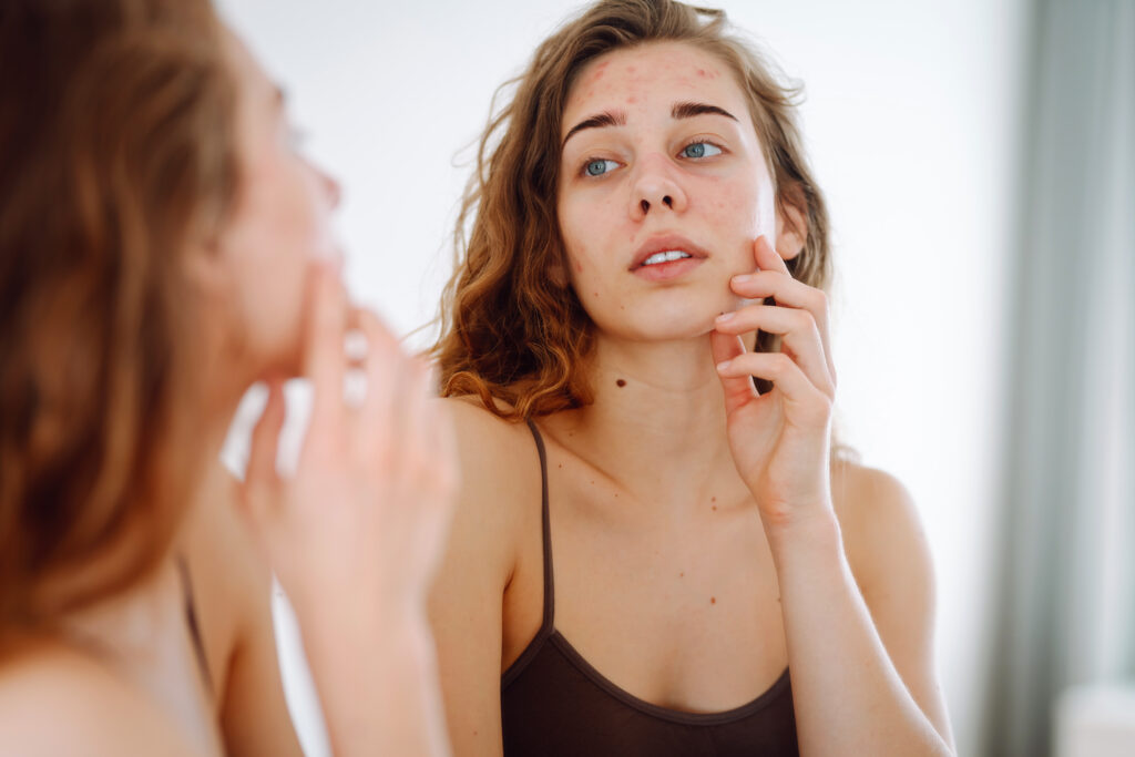 Can Weed Make You Breakout? The Science Behind Cannabis and Acne-can weed make you breakout_2.jpg