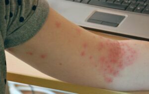 Is a rash a side effect of weaning off of xanax?-Common-Side-Effects-pt.-3.jpg