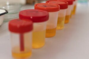 Does lsd show up on urine test?-analysis-in-a-medical-laboratory-2024-10-11-04-14-07-utc.jpg