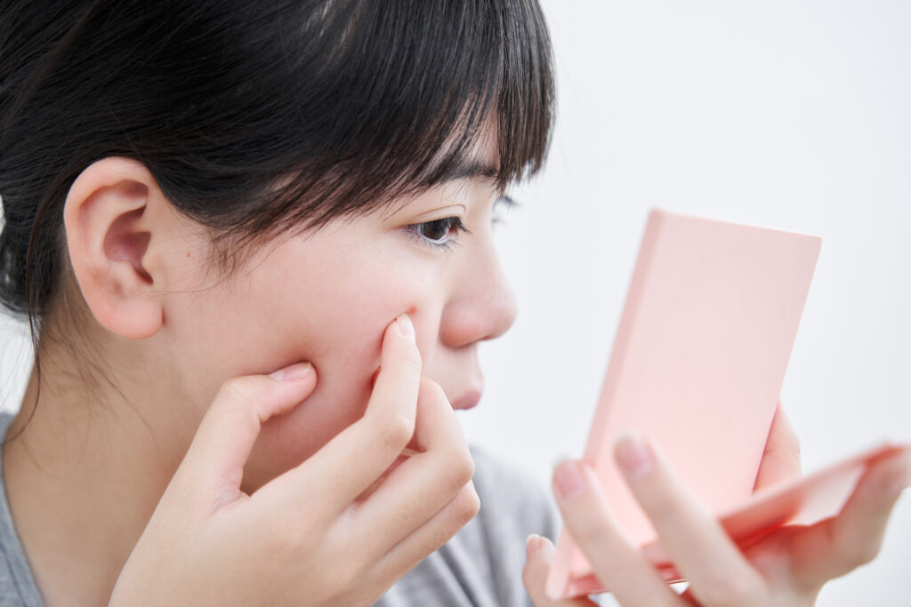 Can Edibles Cause Acne?-edibles acne 1.jpg