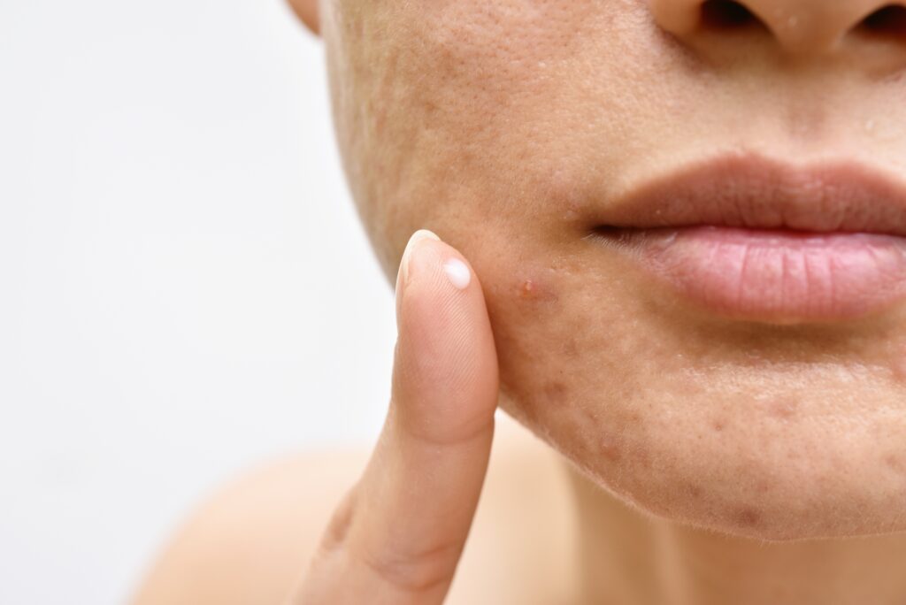 Meth Acne: Causes, Effects, and Recovery-meth acne 1.jpg