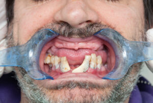 What does meth mouth look like?-meth-mouth.jpg