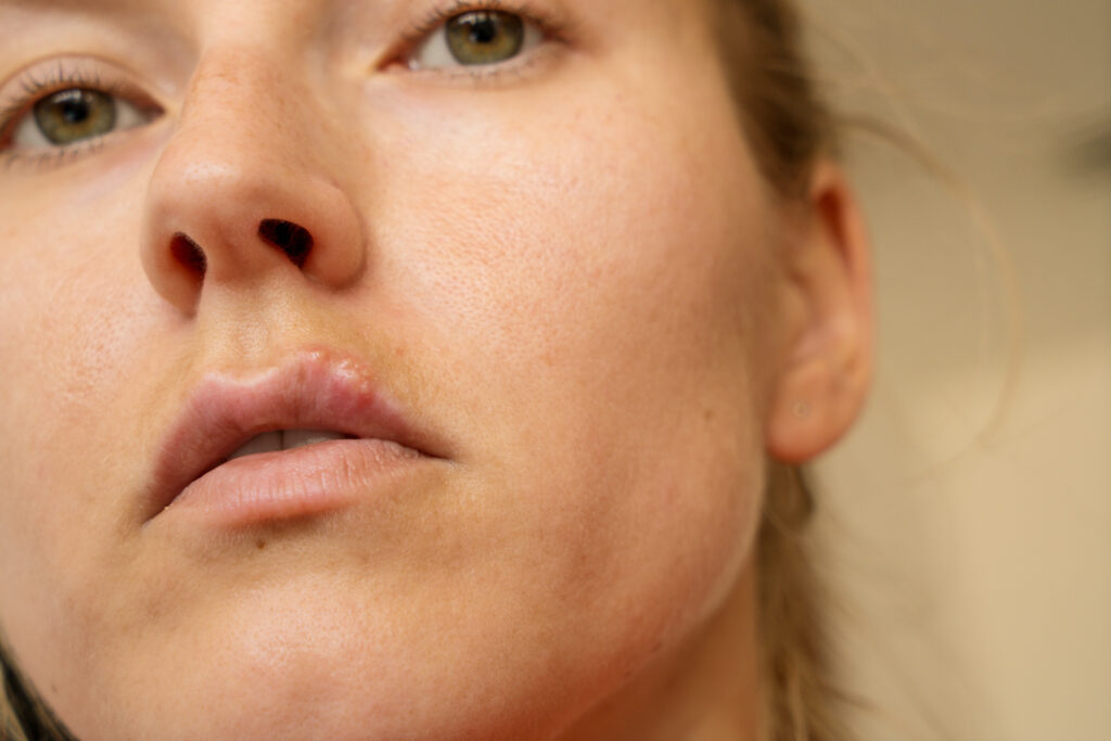 Understanding Meth Sores: Recognition, Treatment, and Recovery-meth sores1.jpg