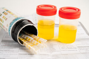 Does lsd show up on a drug urine test?-urine-test-lsd-show.jpg