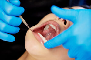 What is meth mouth?-what-is-meth-mouth.jpg